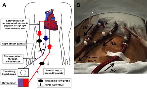 left ventricular venting